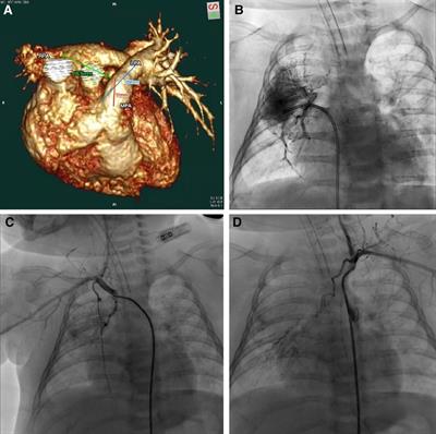 Case report: Reconstruction of the long-gap unilateral absence of right pulmonary artery with contralateral pulmonary artery flap and autologous pericardial graft